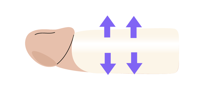 Agrandamiento de la circunferencia del pene