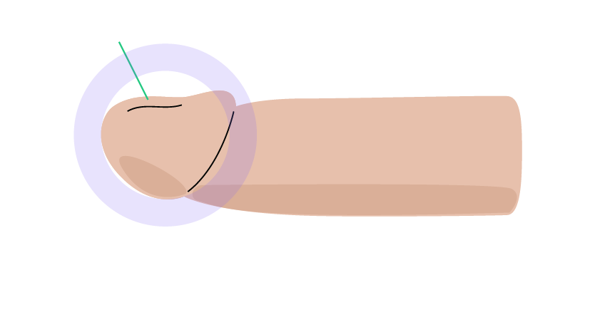 Agrandamiento del glande<br />

