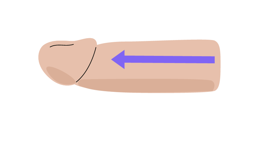 Alargamiento del pene