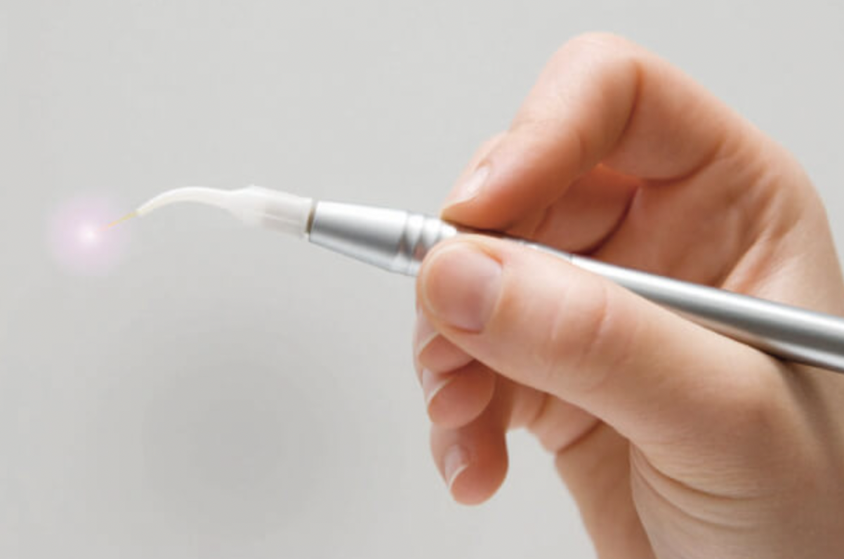 Circuncisión con láser CO2