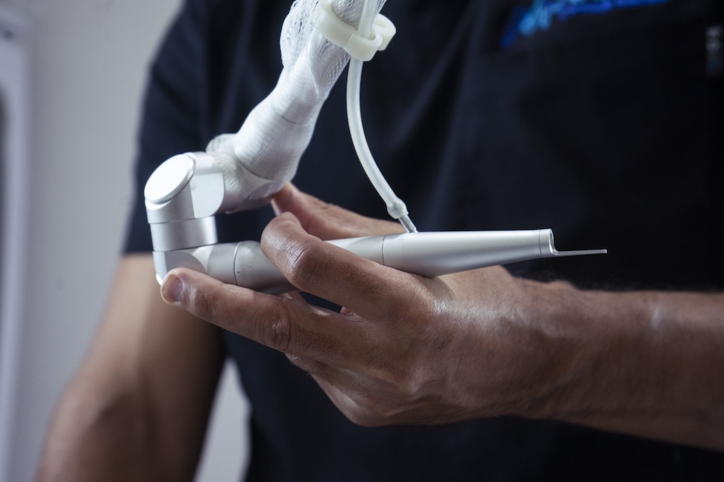 Eliminación de verruga con láser CO2<br />
