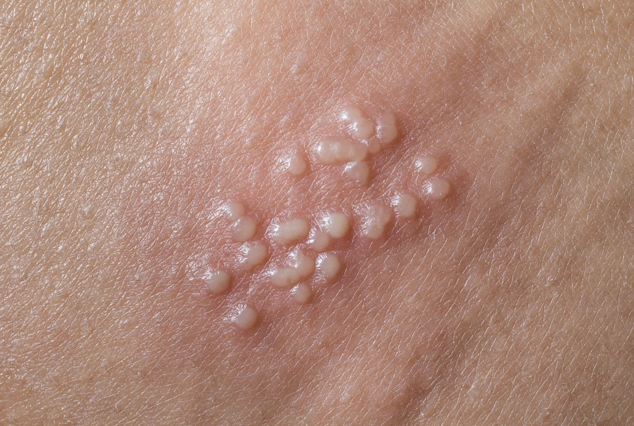 Infecciones de transmisión sexual