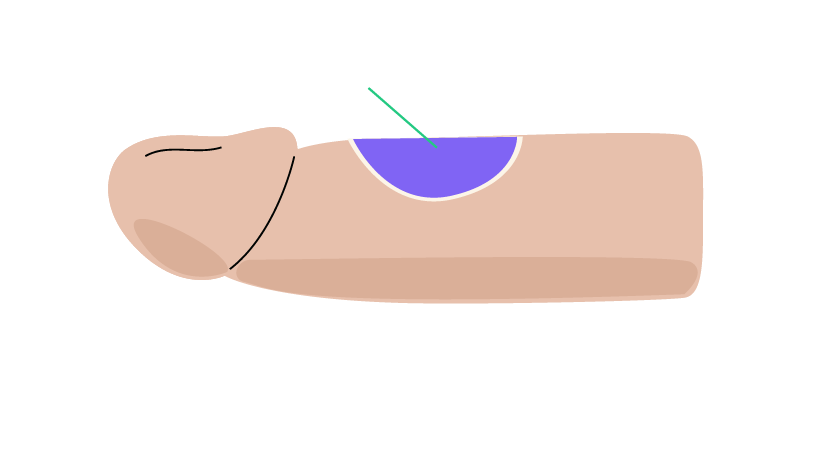 La corrección de la eyaculación precoz