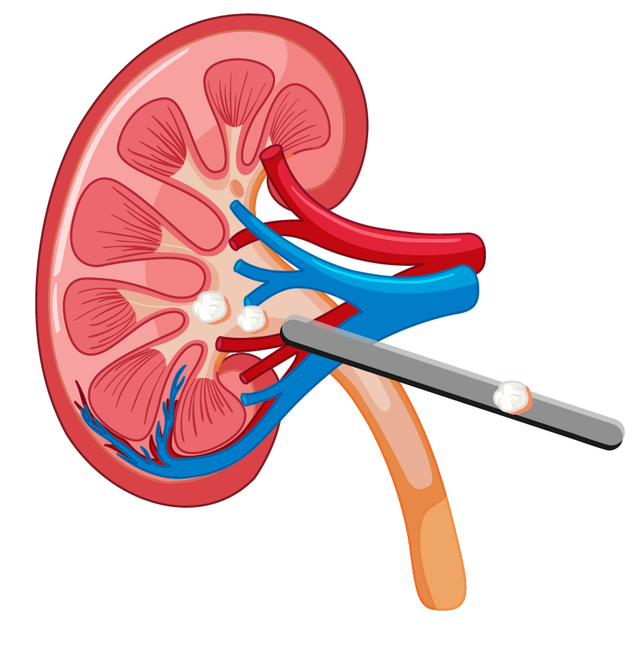 NLP Nefrolitotomía percutánea